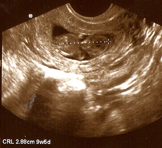  photo 9andahalfweeks_zpsf96b4f22.jpg